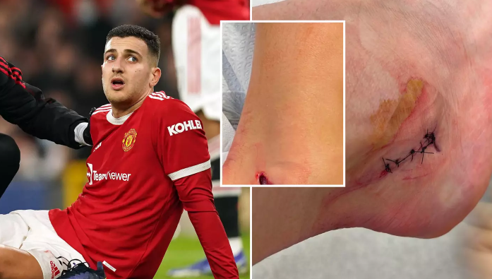 Dalot dính chấn thương, MU lo sốt vó